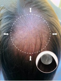 3 "* 3" I Capelli Umani A Base Di Pelle Completa Coprono Le Toppe Per Capelli Nessuna Soluzione Chirurgica Per L'Alopecia Areata