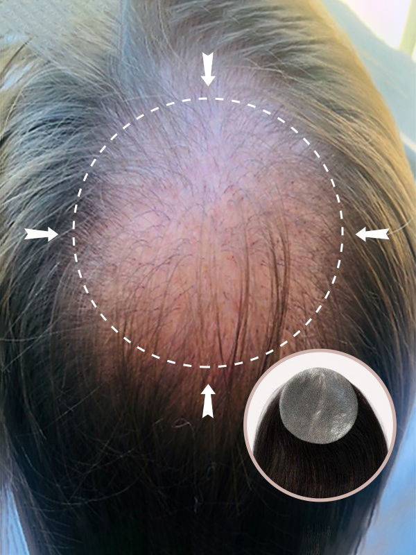 3 "* 3" I Capelli Umani A Base Di Pelle Completa Coprono Le Toppe Per Capelli Nessuna Soluzione Chirurgica Per L'Alopecia Areata